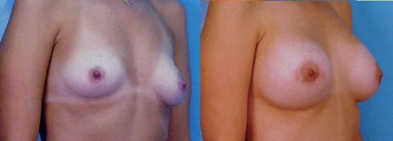 breast12