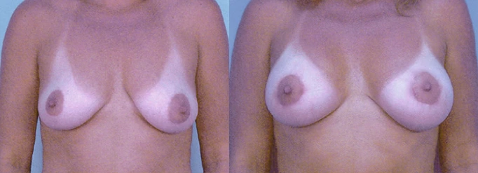 breast13