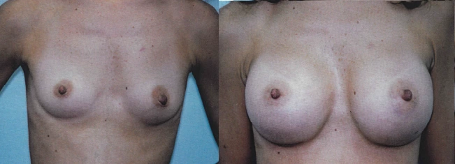 breast19