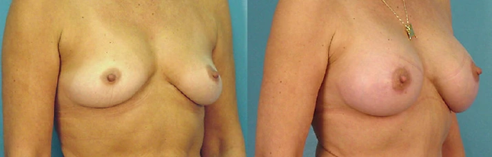 breast2