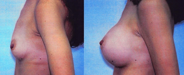 breast20