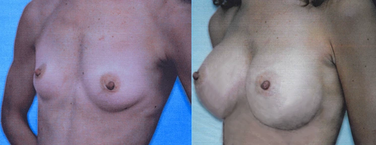 breast21