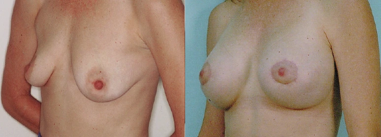 breast5