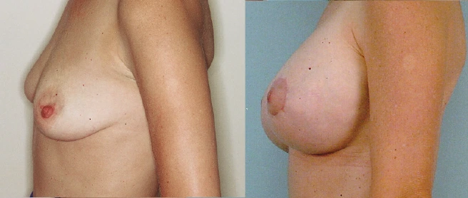 breast6
