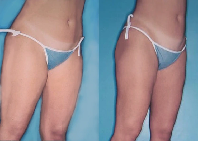 lipo4