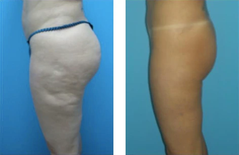 lipo7