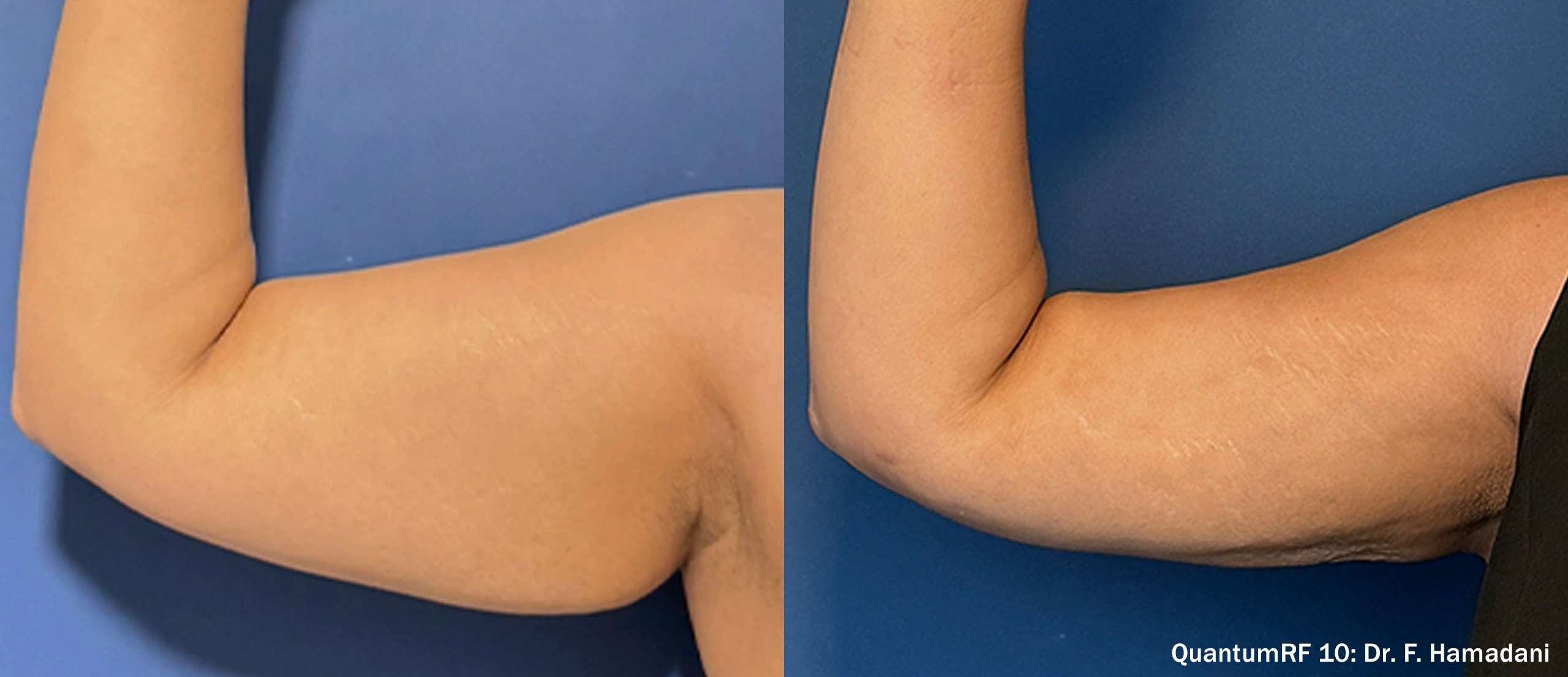 FH_QuantumRF_Arms_Female_RArm_Front_TM