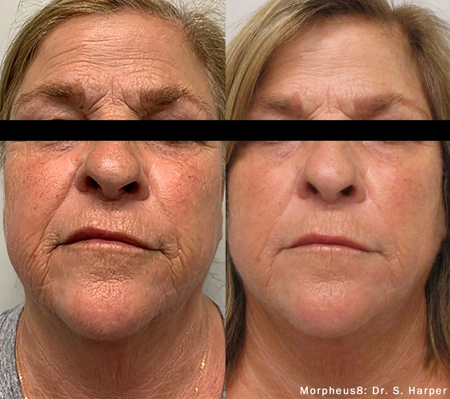 morpheus8-before-after-dr-s-harper-preview-1