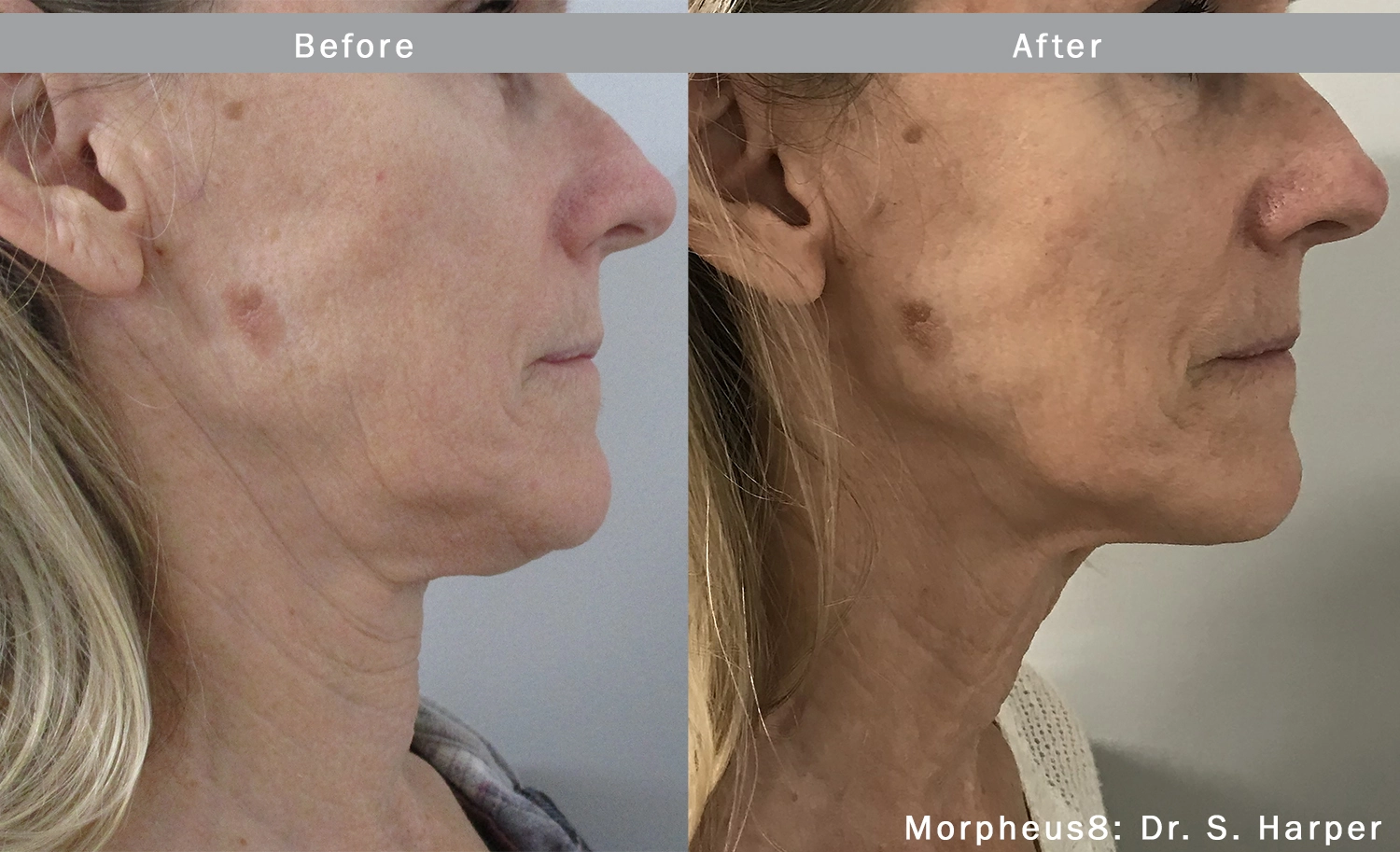 morpheus8-before-after-dr-s-harper-preview-4