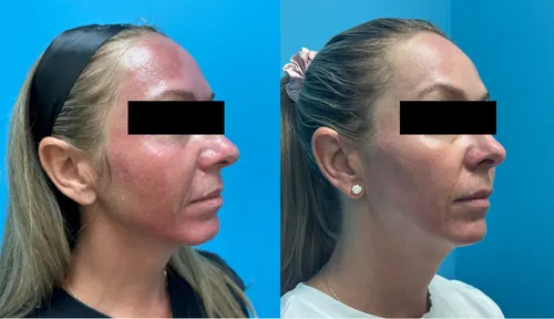 Before and After