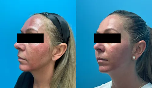 Before and After