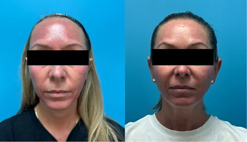 Before and After