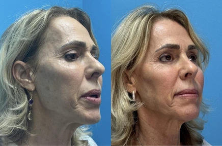 Before and After