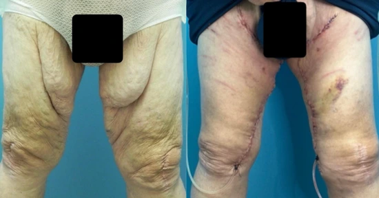 Thighplasty - Before and After