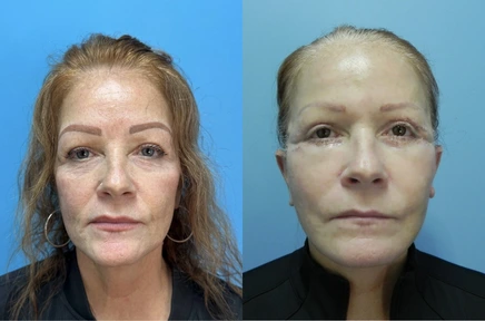 Before and After (2)