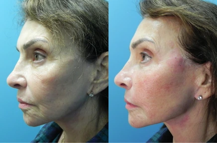 facelist-case-14-436 (2)